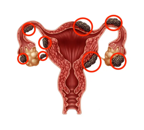 Endometriosis